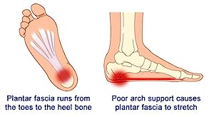 plantar