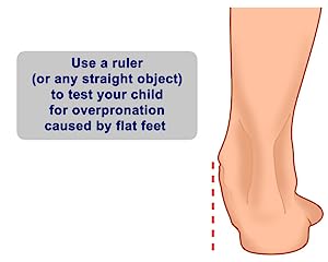 test overpronation