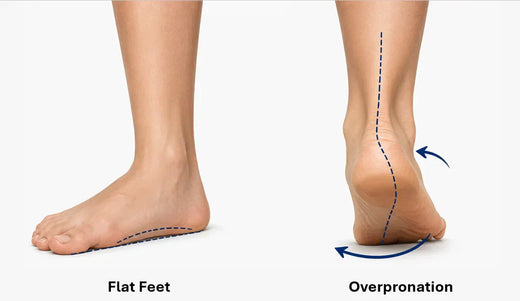 Flat Feet vs. Overpronation: What’s the Difference?
