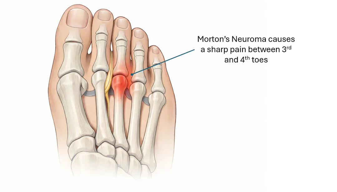 Morton’s Neuroma Symptoms and Metatarsalgia Pain