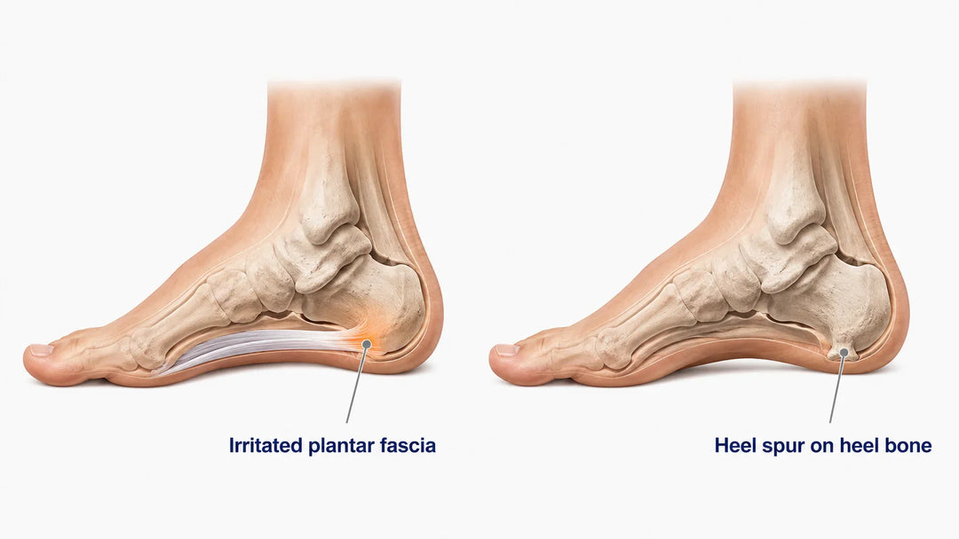 Plantar Fasciitis vs. Heel Spurs: How to Tell the Difference
