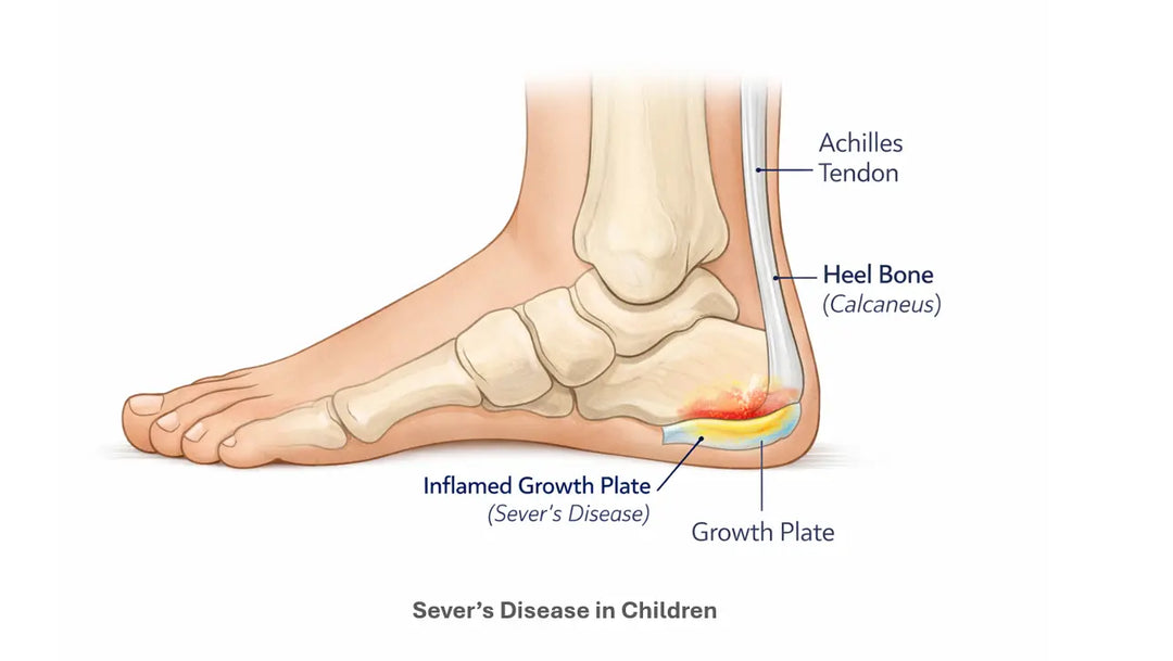 Sever's Disease in Children: Understanding Heel Pain During Growth
