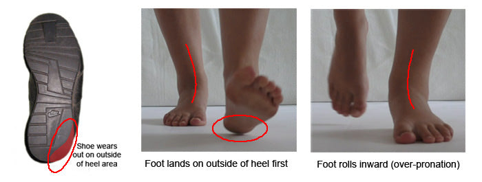 Shoe heel wear pattern showing overpronation