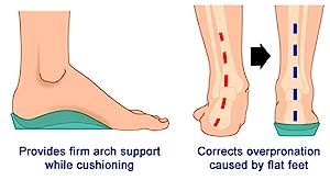 overpronation