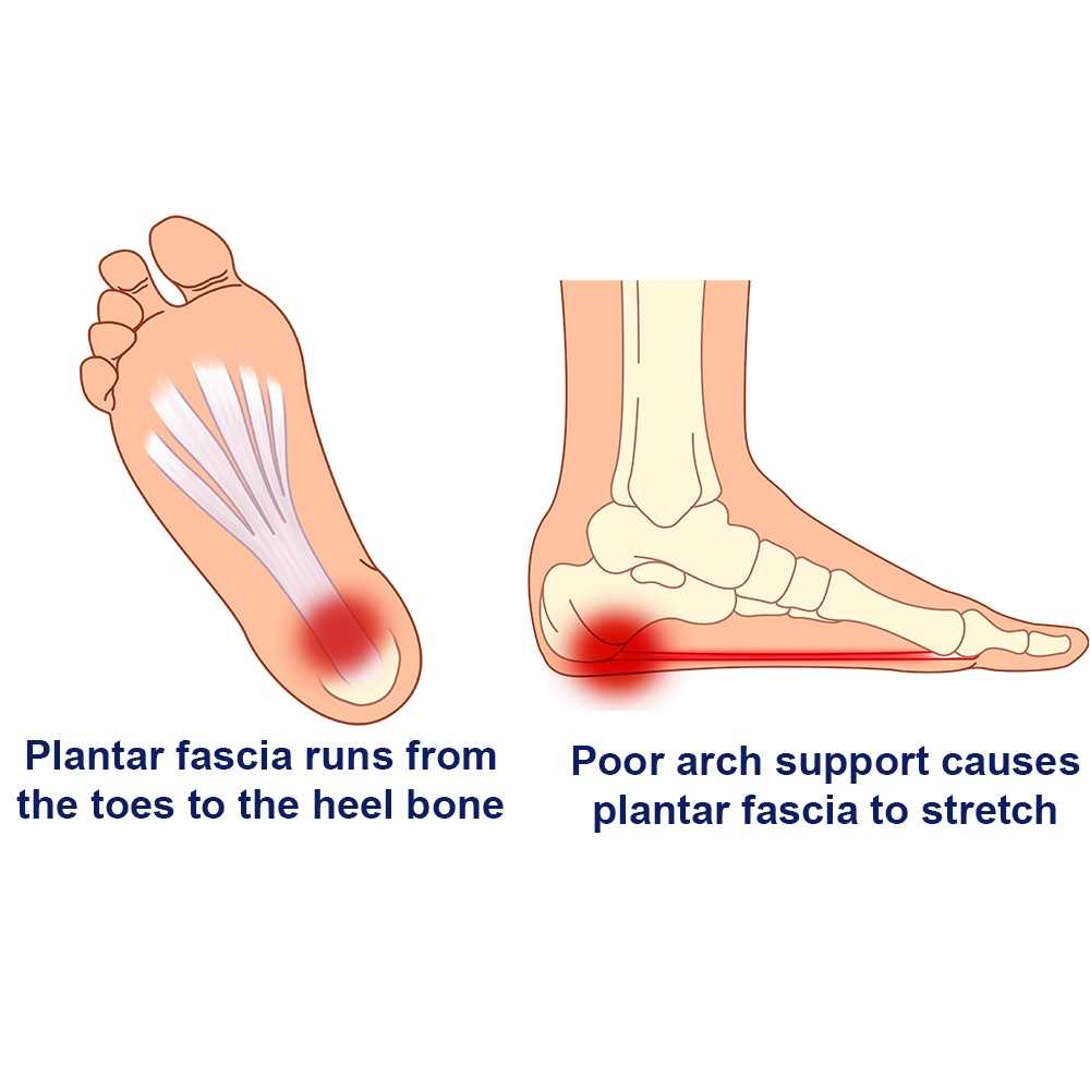 Illustration of plantar fascia with anatomical labels on a white background