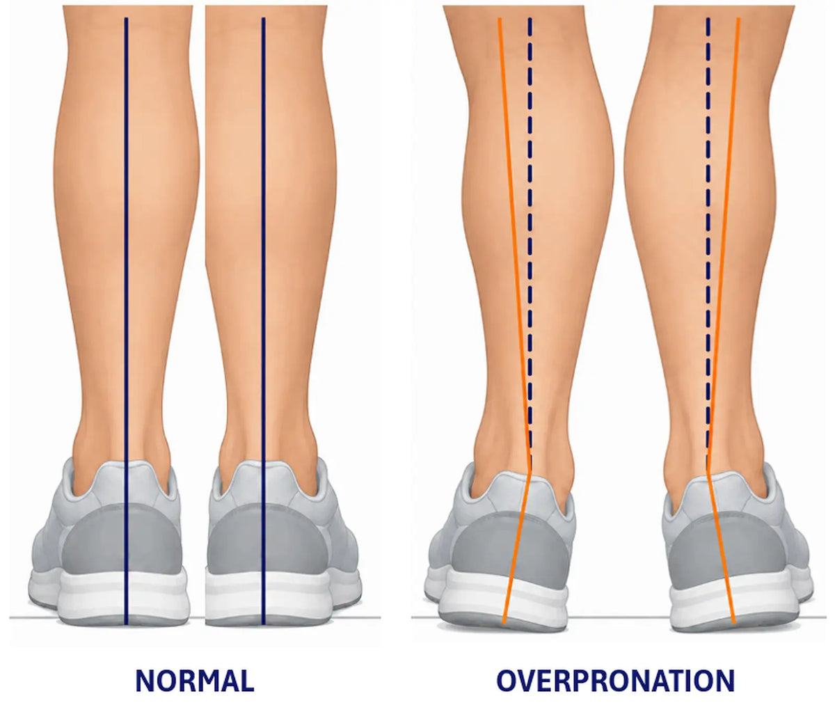 Rear view comparison of both legs: stacked straight in normal alignment, and rolled inward at the ankles with the knees drifting in during overpronation
